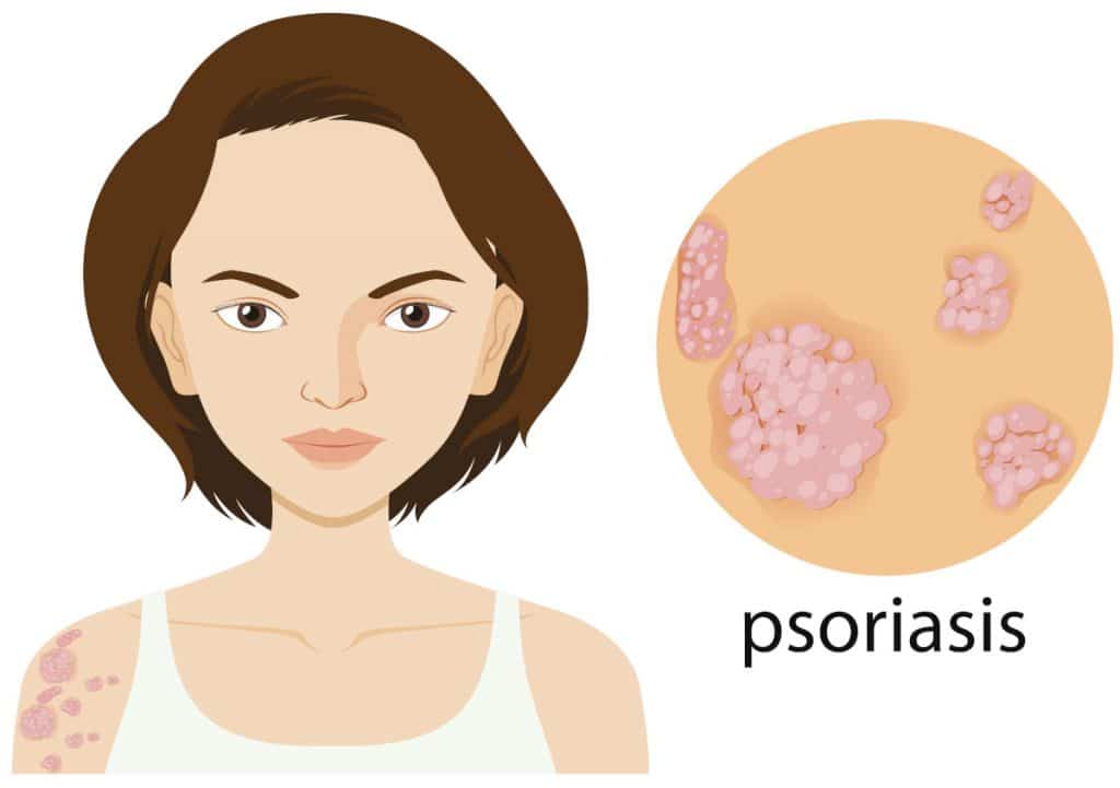 Psoriasi malattia autoimmune Dermatologia