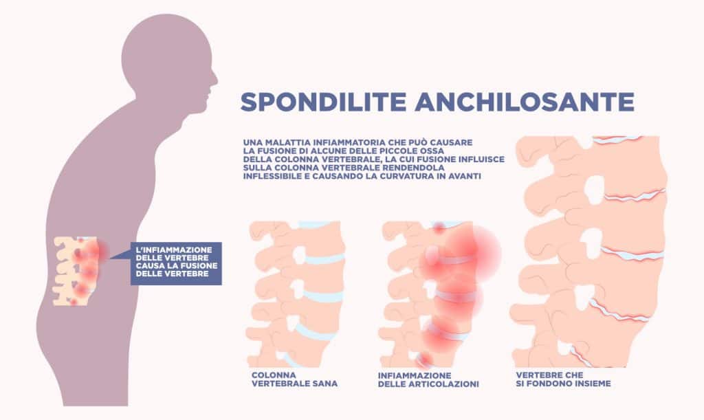 La spondilite anchilosante: cos'è