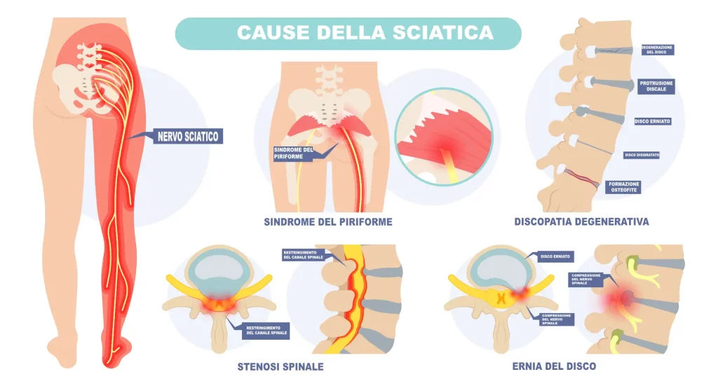 Le cause della sciatica